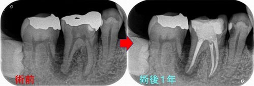 感染根管治療 Retreatment - 株式会社 ヒョーロン
